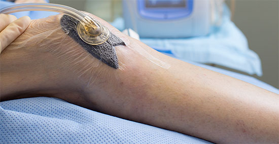 wound-vac-vacuum-assisted-closure-of-a-wound-university-foot-and